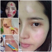 Thuốc trị sẹo HIRUSCAR Thái Lan